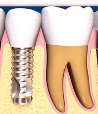 Visa tiesa apie implantus