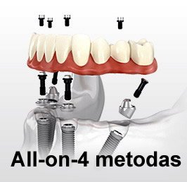 Nobel Biocare implantai ir all-on-4