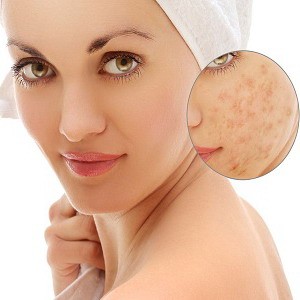 Lazerių panaudojimas dermatologijos klinikoje Lazerių panaudojimas dermatologijos klinikoje