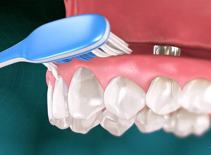 dantų implantų valymas