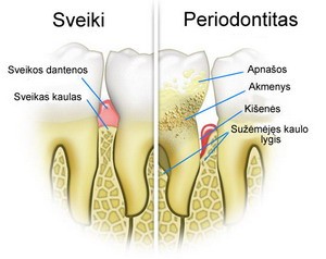Periodontito gydymas