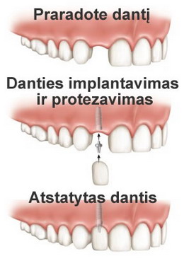 Danties implantavimas